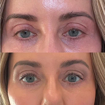 Non-Surgical Eye Lift in Wilmington, NC