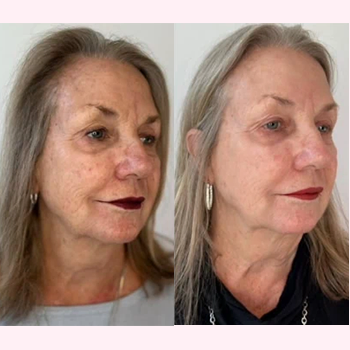 Dermal Fillers in Wilmington, NC