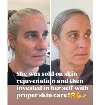 Dermal Fillers in Wilmington, NC