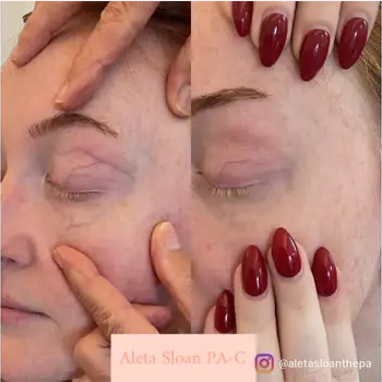 Dermal Fillers in Wilmington, NC