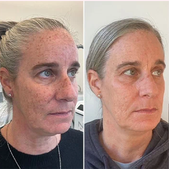 Dermal Fillers in Wilmington, NC