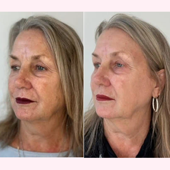 Dermal Fillers in Wilmington, NC