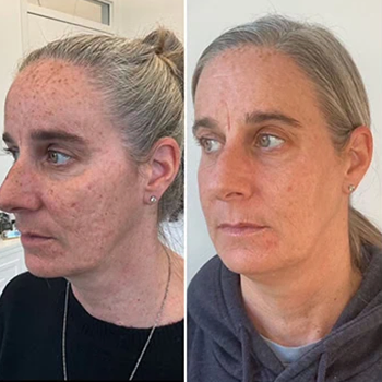 Dermal Fillers in Wilmington, NC