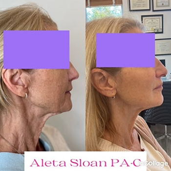 Restylane in Wilmington, NC | United Medical & Aesthetics