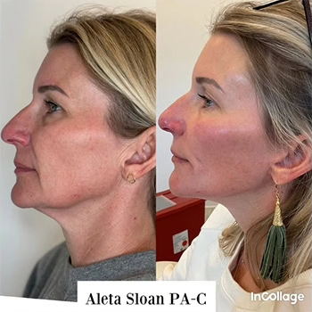 Restylane in Wilmington, NC | United Medical & Aesthetics