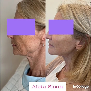 Restylane in Wilmington, NC | United Medical & Aesthetics