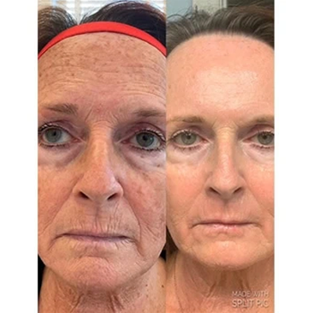 Dermal Fillers in Wilmington, NC