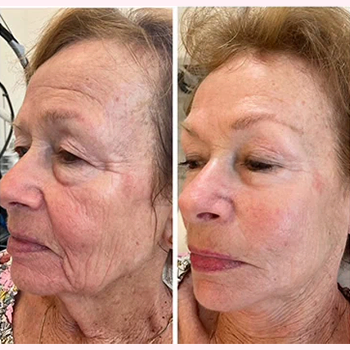 Dermal Fillers in Wilmington, NC