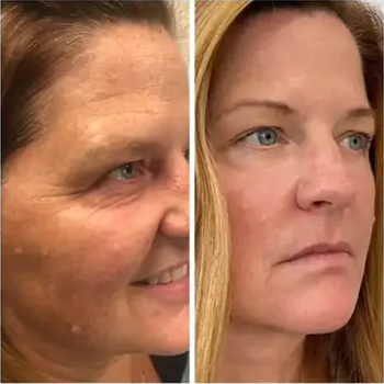 Dermal Fillers in Wilmington, NC
