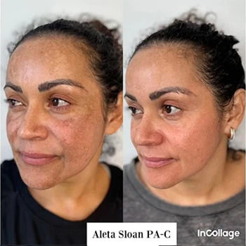 Dermal Fillers in Wilmington, NC