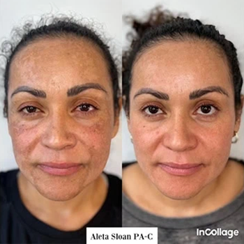 Dermal Fillers in Wilmington, NC