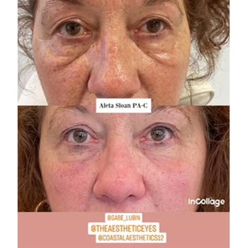 Dermal Fillers in Wilmington, NC