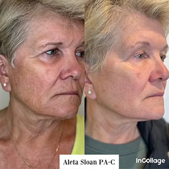Dermal Fillers in Wilmington, NC