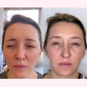 Botox® in Wilmington, NC