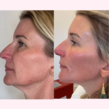 Facial Rejuvenation in Wilmington, NC