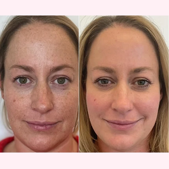 Facial Rejuvenation in Wilmington, NC