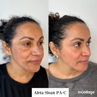 Facial Rejuvenation in Wilmington, NC at United Medical And Aesthetics