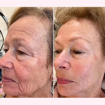 Facial Rejuvenation in Wilmington, NC