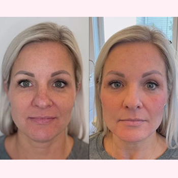 Facial Rejuvenation in Wilmington, NC