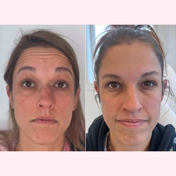 Jeuveau Treatment in Wilmington, NC