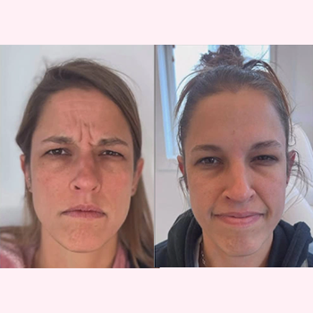 Jeuveau Treatment in Wilmington, NC
