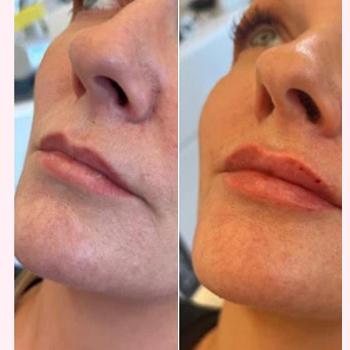 Revanesse Lips in Wilmington, NC | United Medical & Aesthetics