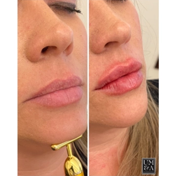 Revanesse Lips in Wilmington, NC | United Medical & Aesthetics