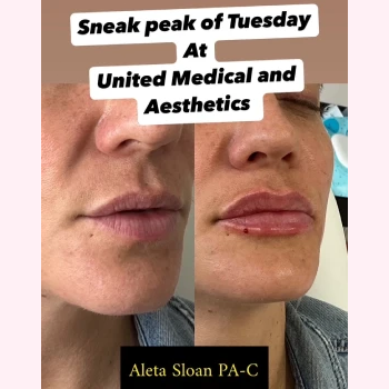 Revanesse Lips in Wilmington, NC | United Medical & Aesthetics