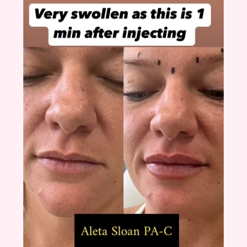Revanesse Lips in Wilmington, NC | United Medical & Aesthetics