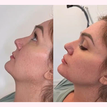 Revanesse Versa in Wilmington, NC | United Medical & Aesthetics