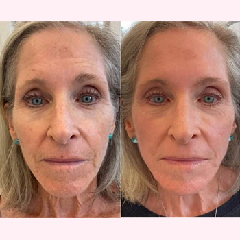 Sculptra in Wilmington, NC