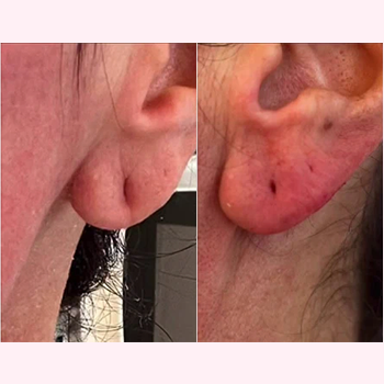 Dermal Fillers in Wilmington, NC