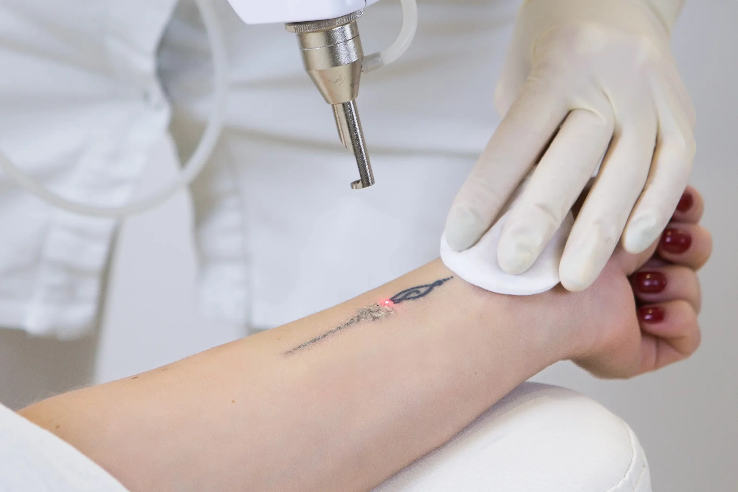 Laser Tattoo Removal in Wilmington, NC