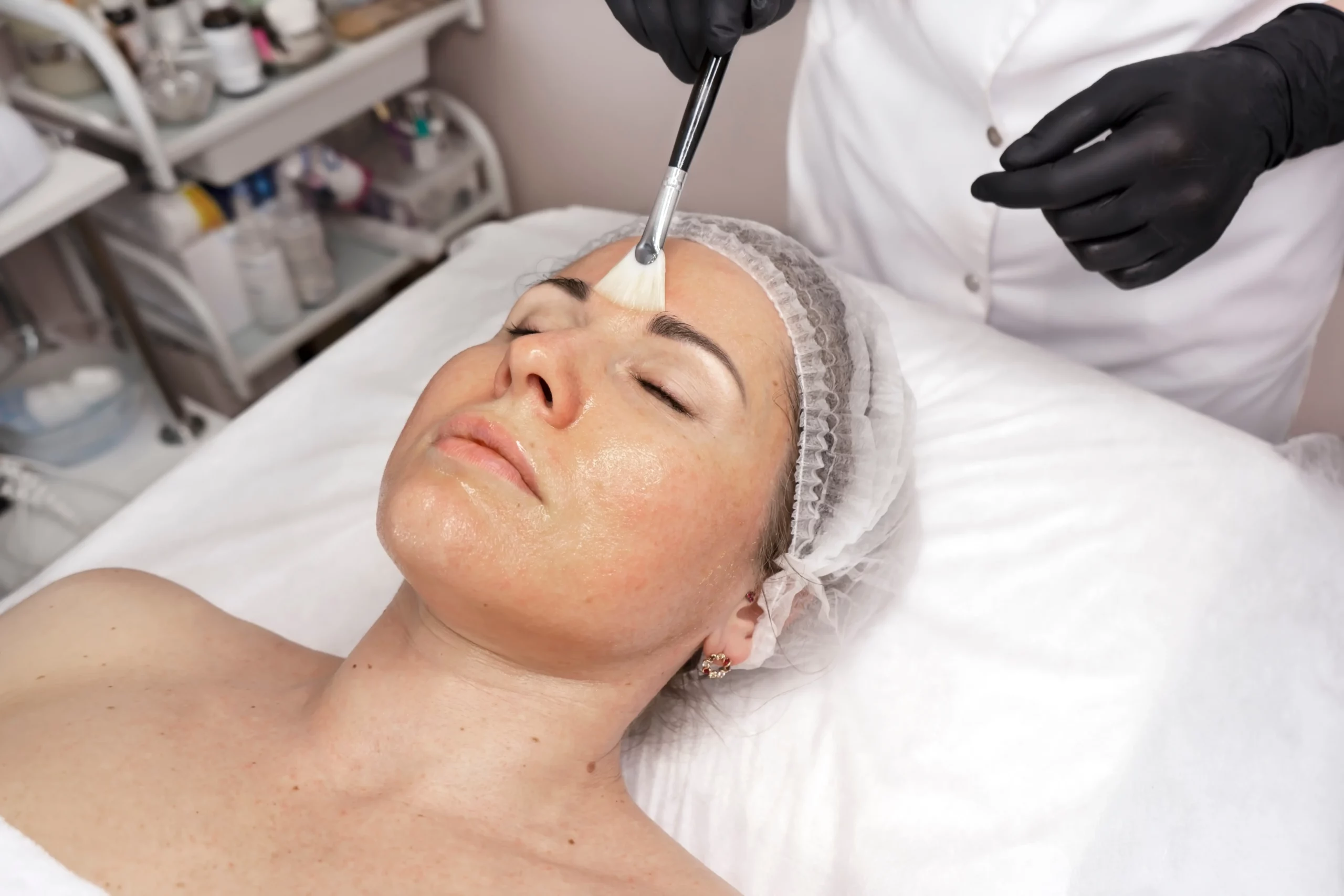 Melasma Treatment with Cosmelan® Peel in Wilmington, NC