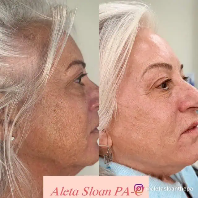 UltraClear Laser Treatment in Wilmington, NC