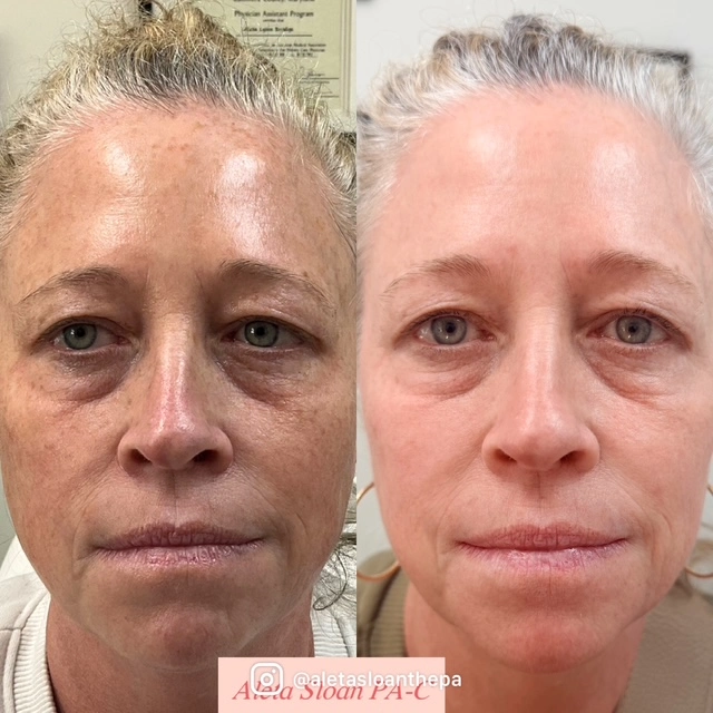 Helix in Wilmington, NC | United Medical & Aesthetics