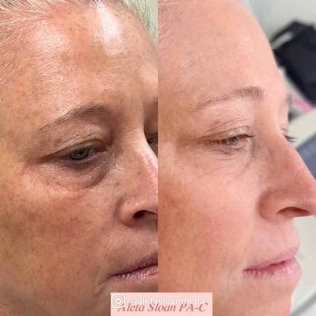 Helix in Wilmington, NC | United Medical & Aesthetics