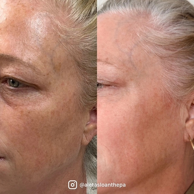Helix in Wilmington, NC | United Medical & Aesthetics