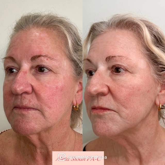Ultraclear treatment Wilmington, NC