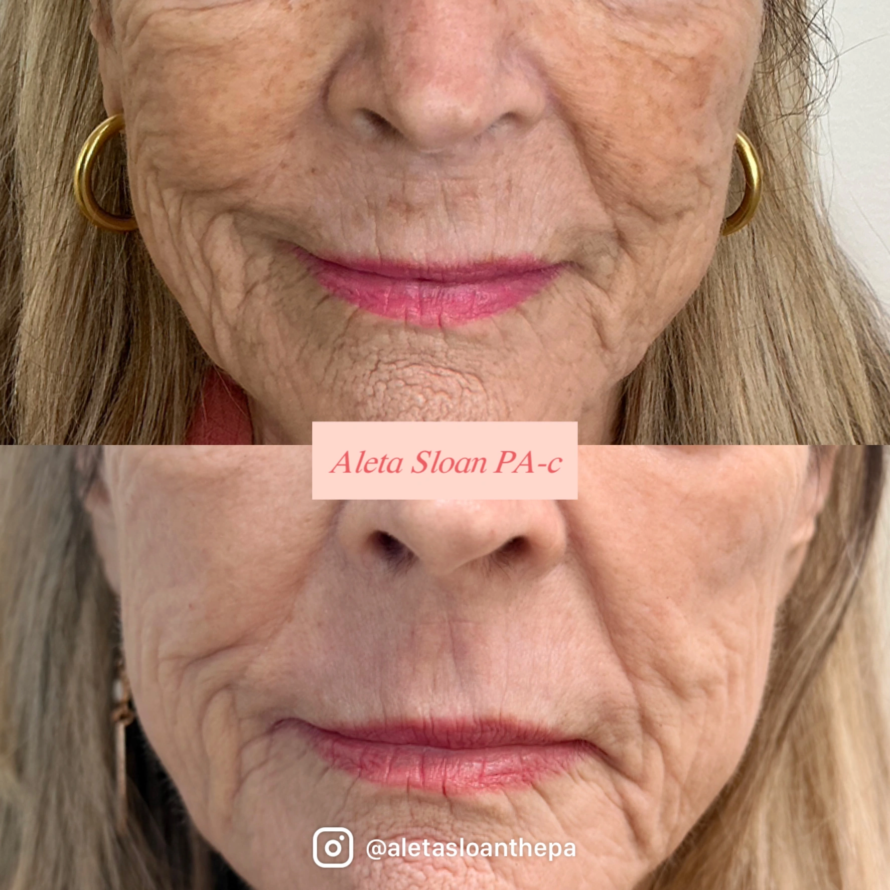 HELIX CO2 Laser Rejuvenation