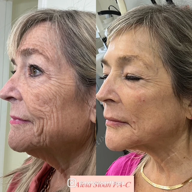 HELIX CO2 laser in Wilmington, NC