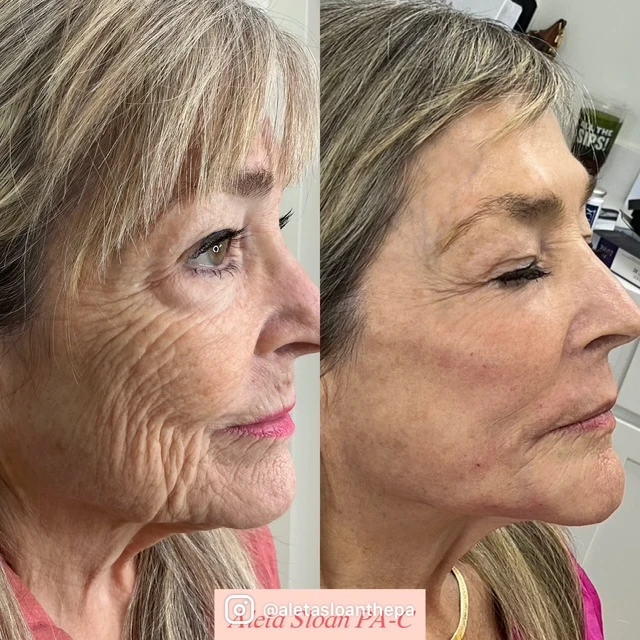 HELIX CO2 laser in Wilmington, NC