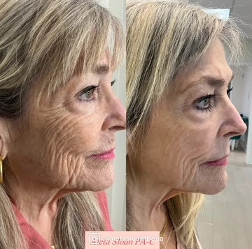 HELIX CO2 laser in Wilmington, NC