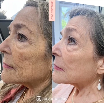 HELIX CO2 laser in Wilmington, NC