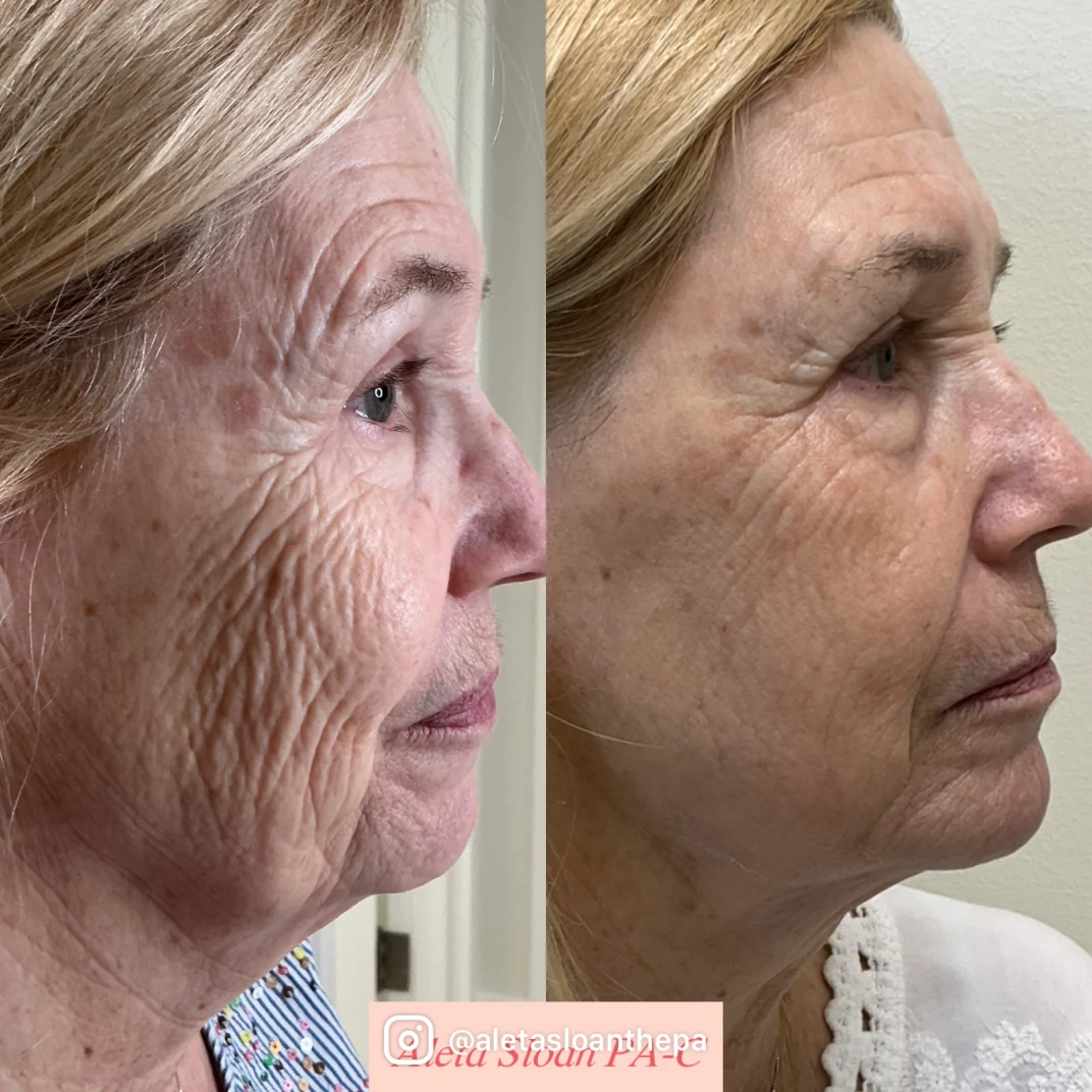Helix Treatment in Wilmington, NC
