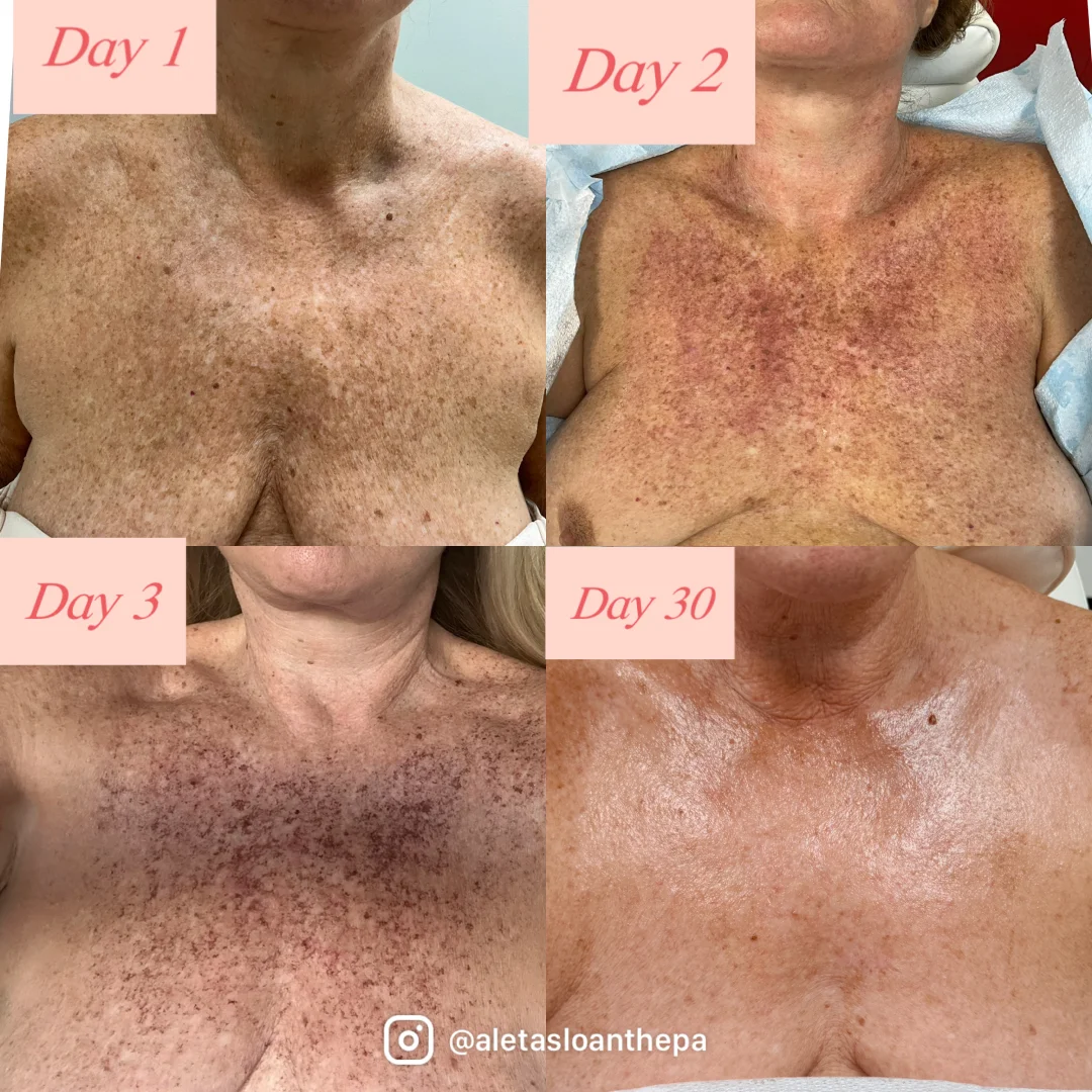 Nordlys Treatment in Wilmington, NC