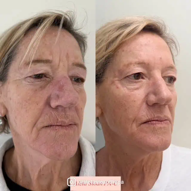 Skin-Rejuvenation in Wilmington, NC