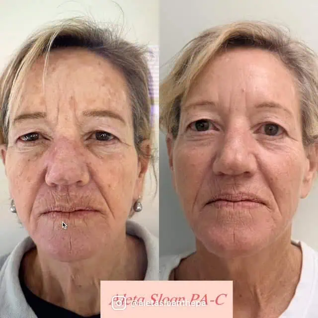 Skin-Rejuvenation in Wilmington, NC
