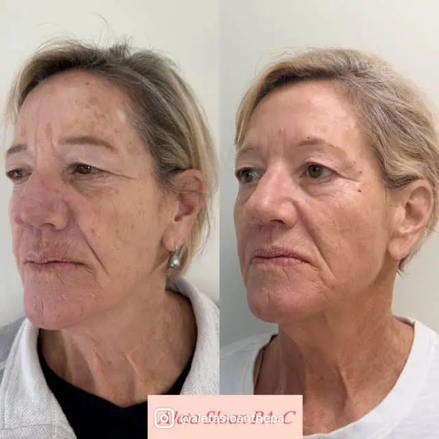Skin-Rejuvenation in Wilmington, NC