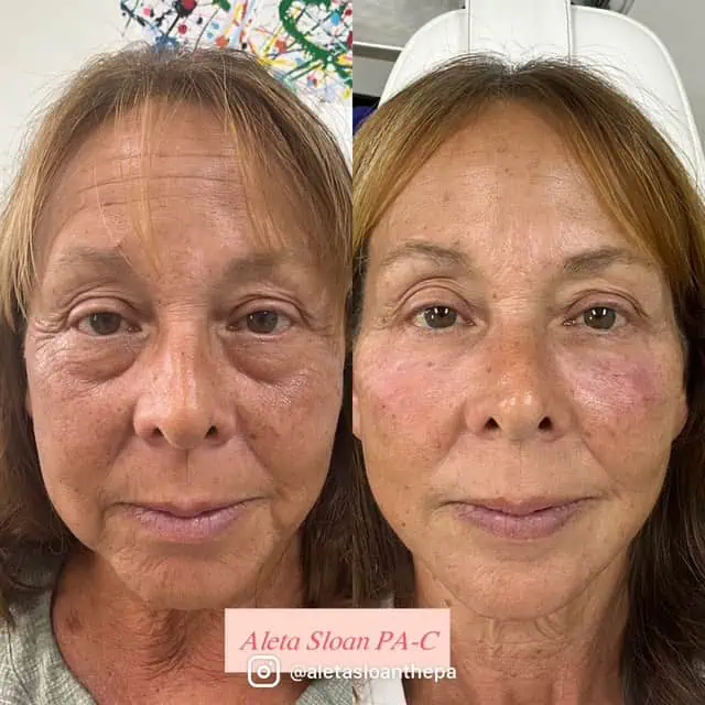 Skin-Rejuvenation in Wilmington, NC